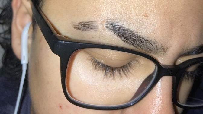 How do I get rid of an eyebrow piercing scar?