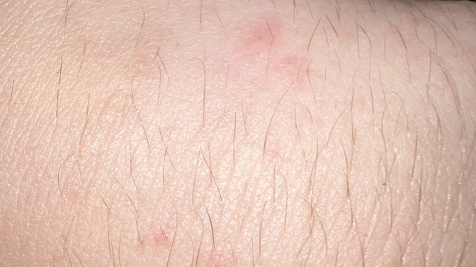 Does anyone know what these bumps are on my hand?