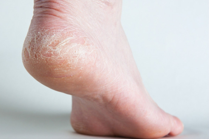 Girls, why are my gf’s feet so cracked and dry?