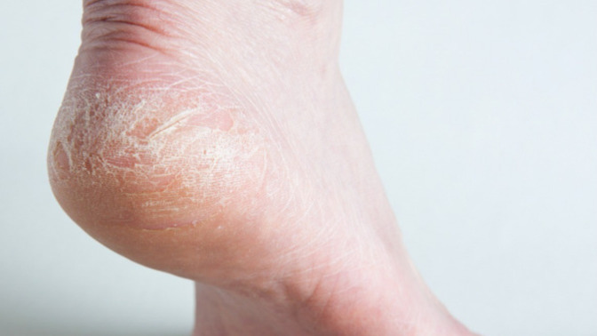 Girls, why are my gf’s feet so cracked and dry?