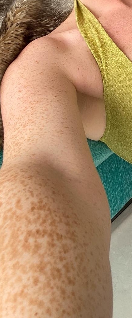 Is it normal on whites arm?