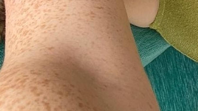 Is it normal on whites' arm?