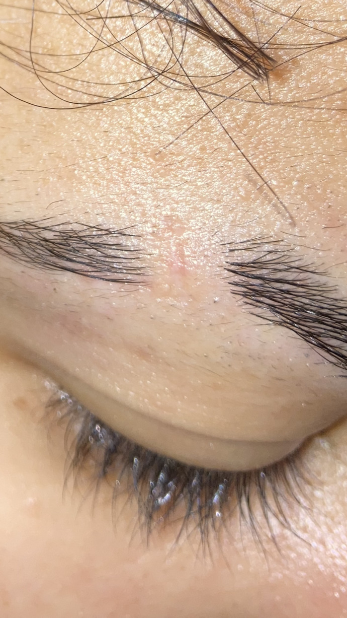 How do I get rid of this eyebrow scar?