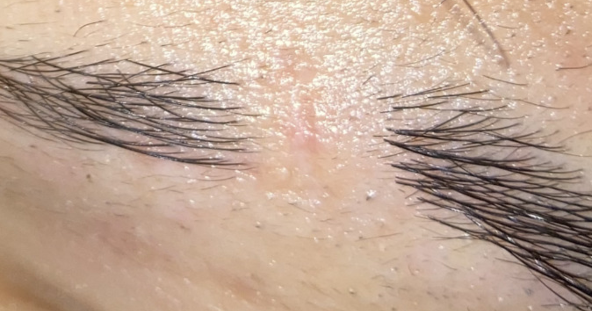 How do I get rid of this eyebrow scar? - GirlsAskGuys