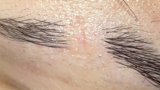 How do I get rid of this eyebrow scar?