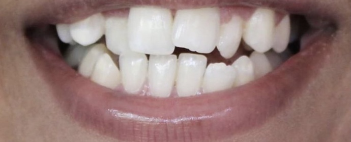 How would you feel about a friend or significant other with teeth exactly like this?