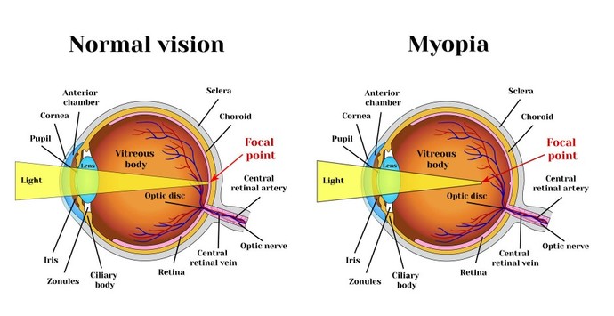 Do you use plus lenses when looking close?