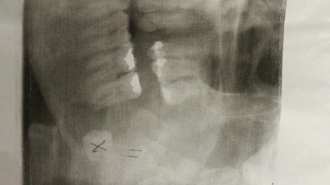 Who still has their wisdom teeth?