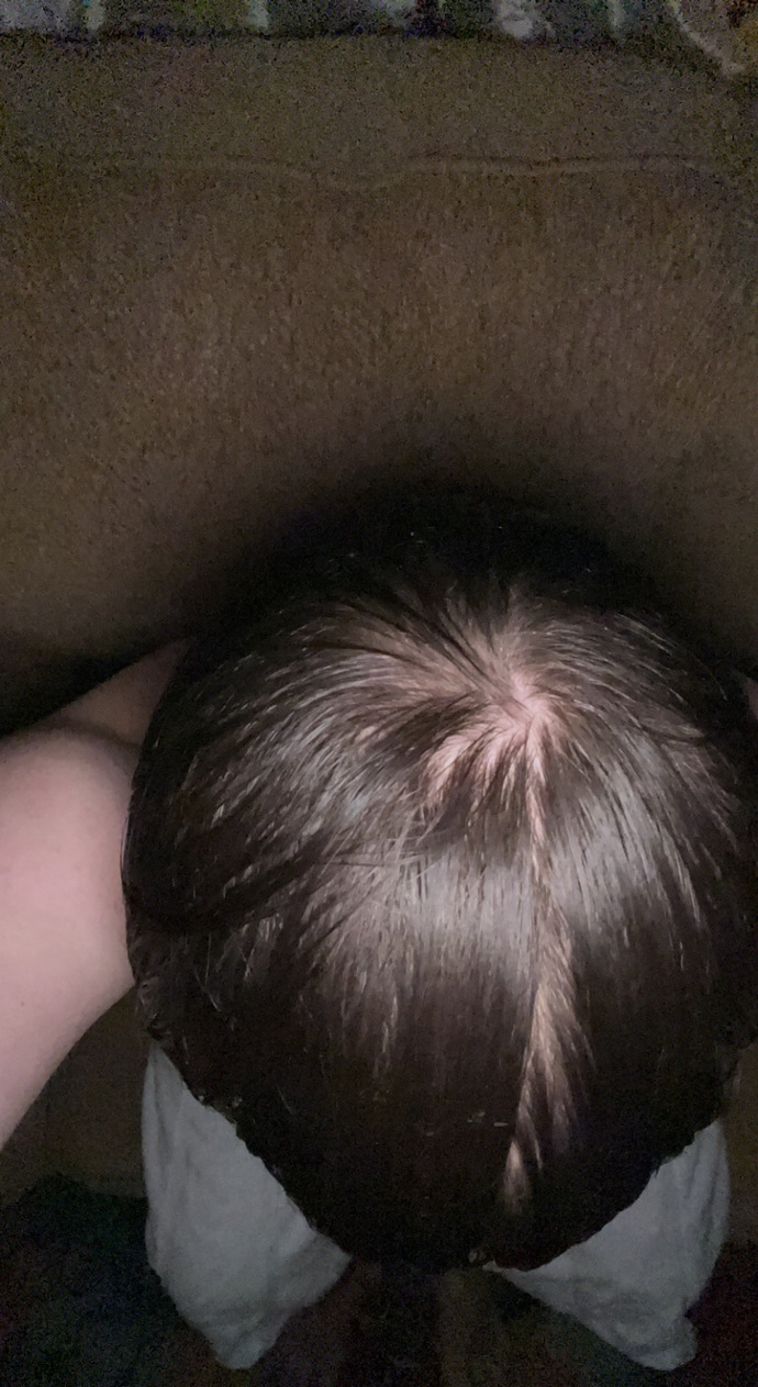 Balding or the way my hair grows in?