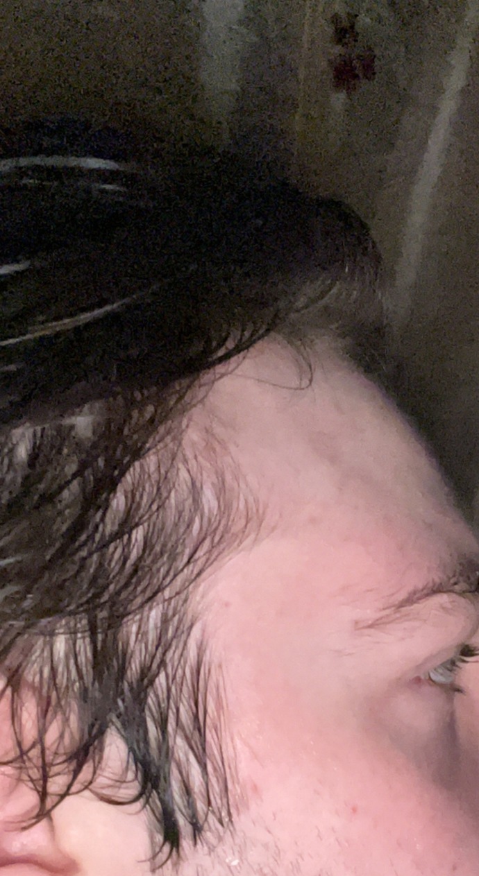 Balding or the way my hair grows in?