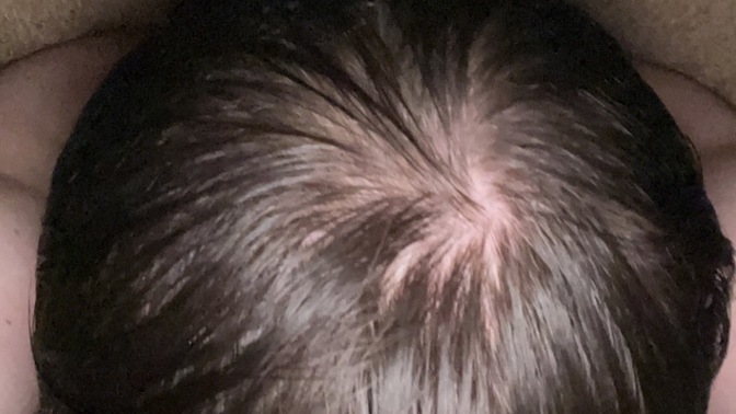 Balding or the way my hair grows in?