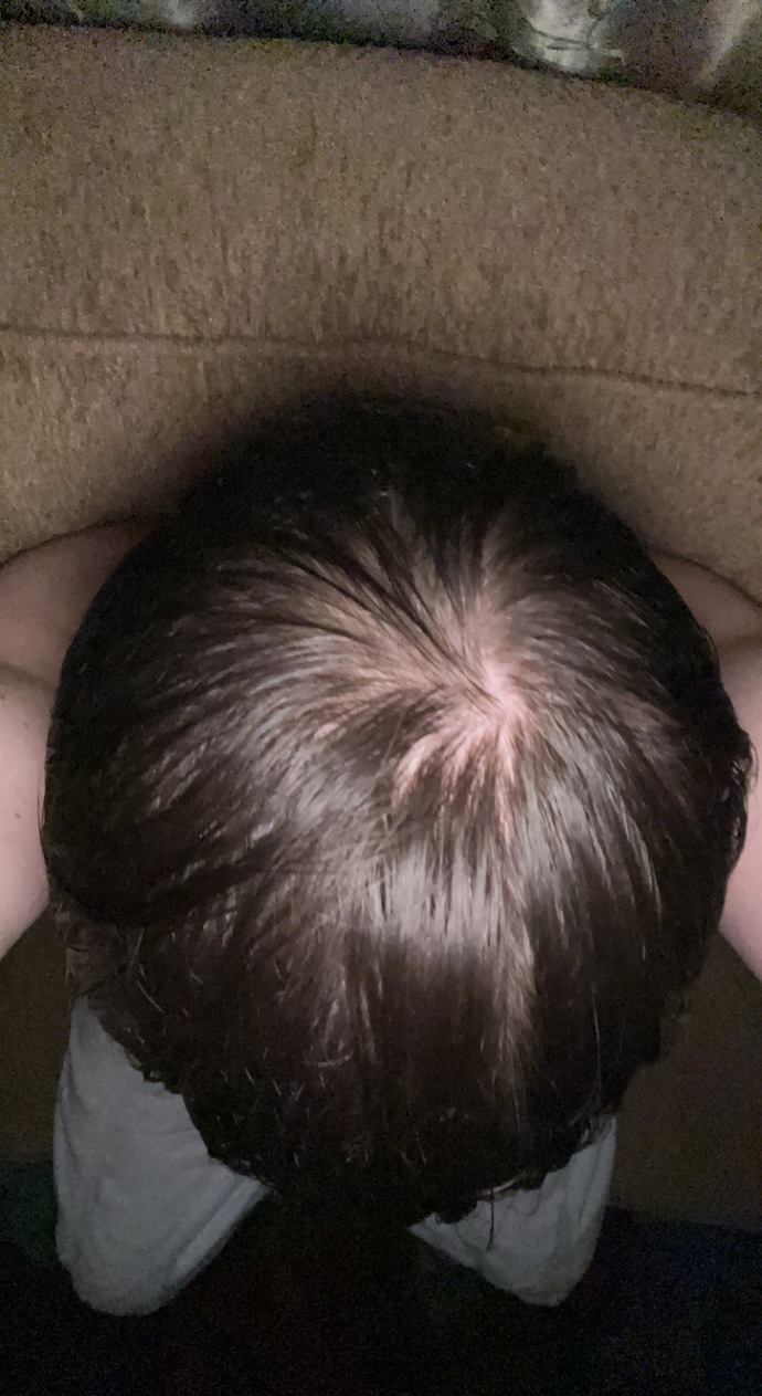 Bald spot or not?