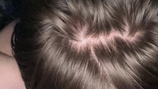 Bald spot or not?