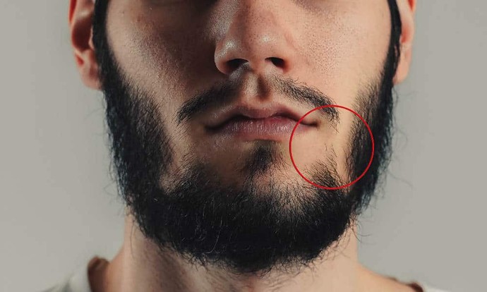Do any other guys have facial hair that doesnt grow in certain areas?