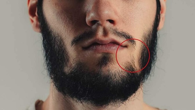 Do any other guys have facial hair that doesn't grow in certain areas?