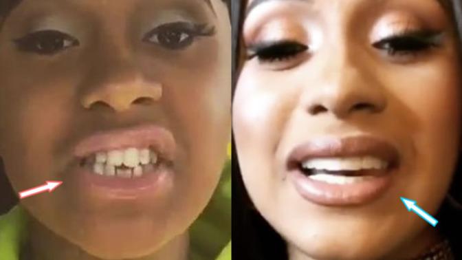 Were Cardi B‘s teeth really thst bad?