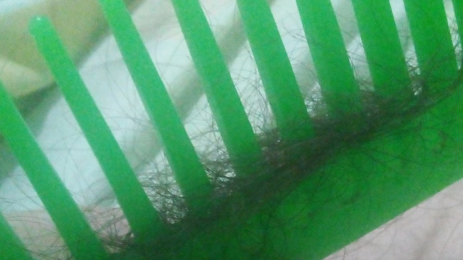 Is it normal for me to lose this amount of hair or should I go to the dermatologist?
