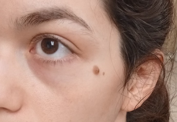 Should I get this mole removed, or leave it as a beauty mark?