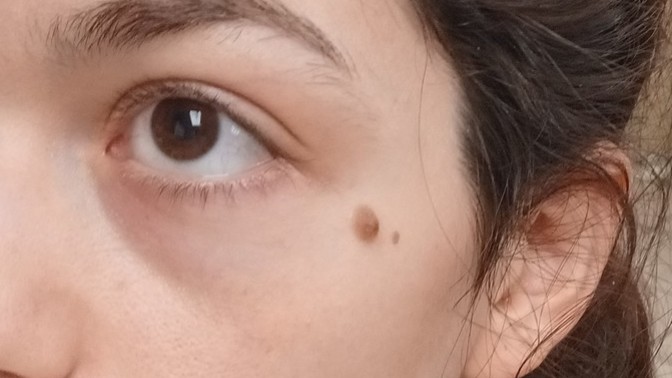 Should I get this mole removed, or leave it as a beauty mark?