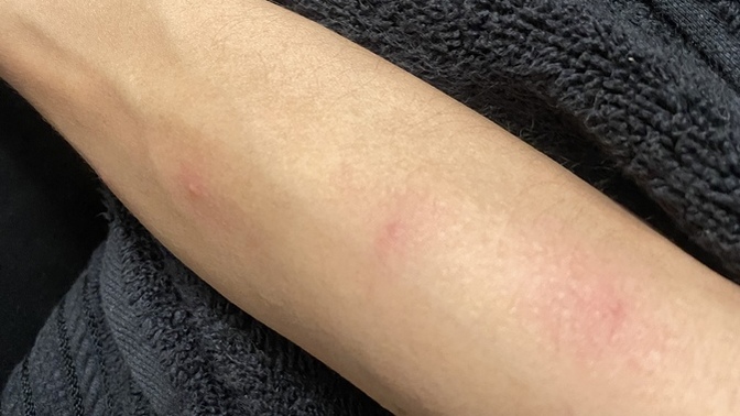 Help why do I have red itchy bumps on my body?