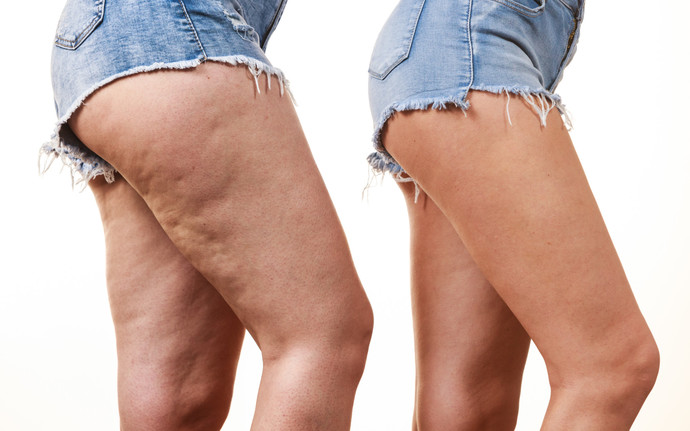 Do guys care about cellulite on a girl?