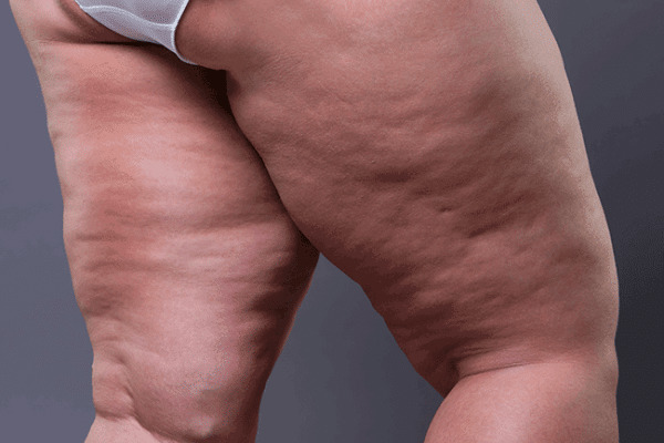 Do guys care about cellulite on a girl?