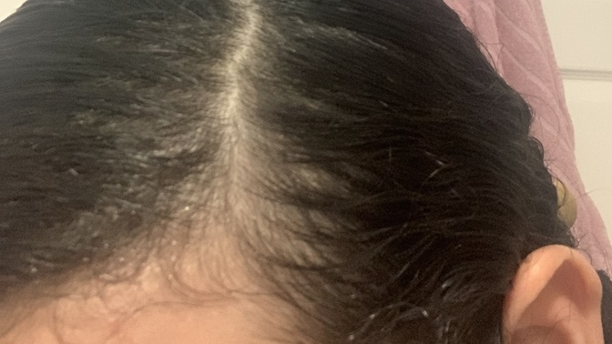 Is this hair loss?