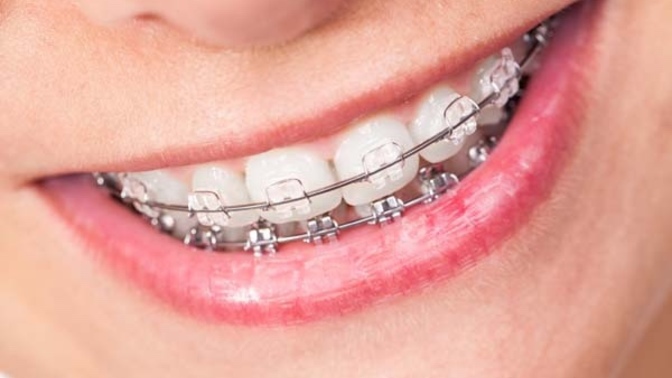 Did you get your braces off earlier than expected?