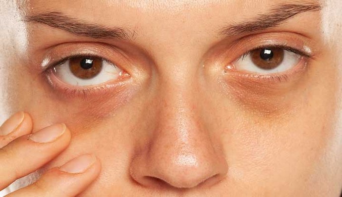 Thoughts on dark circles on your preferred gender?