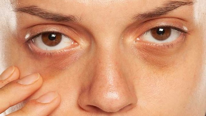 Thoughts on dark circles on your preferred gender?