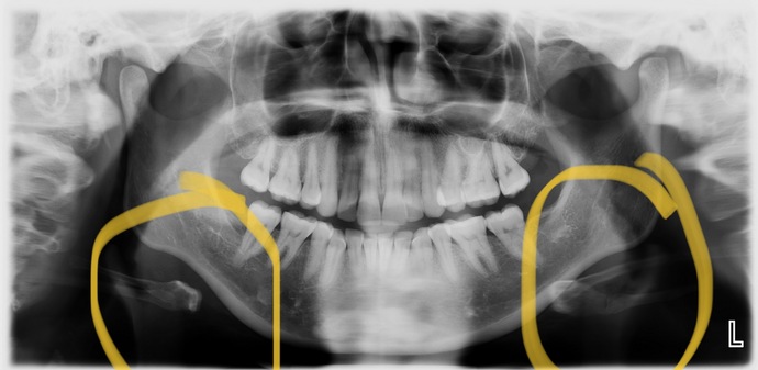 I know most people on GaG are likely not doctors but if you had to take a guess would you say I have an uneven jaw based on this x ray?