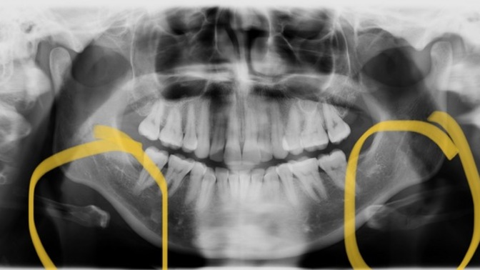 I know most people on GaG are likely not doctors but if you had to take a guess would you say I have an uneven jaw based on this x ray?