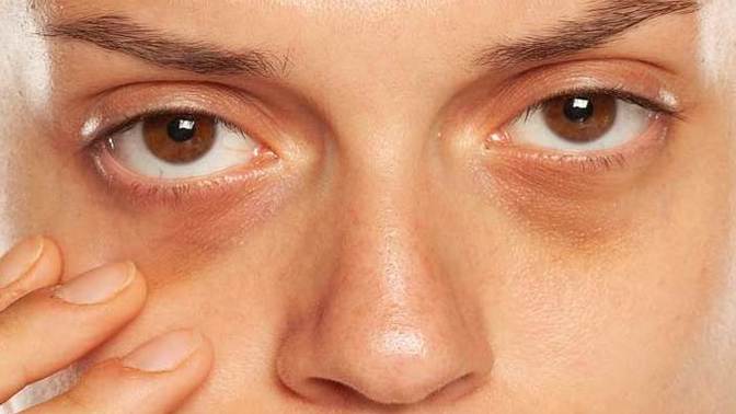 How do I get rid off eye bags?