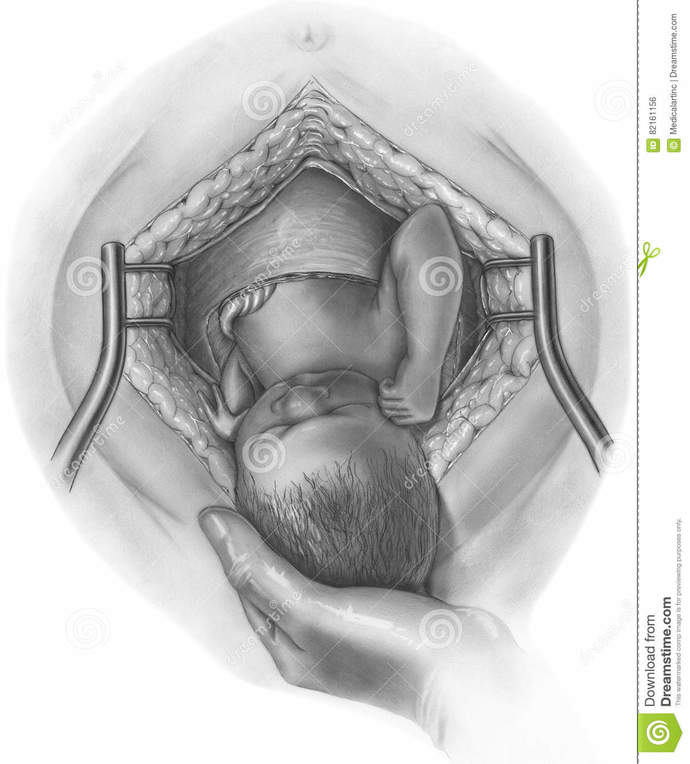 C section or natural birth, which is more horrifying?