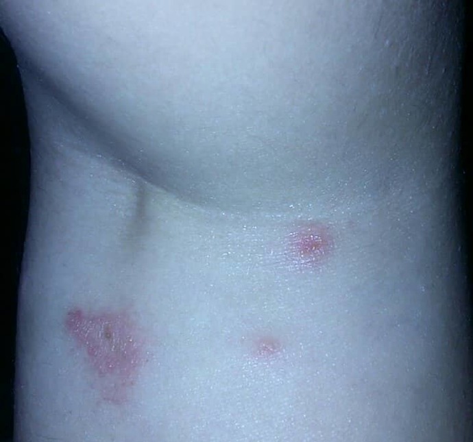 Is this ringworm?