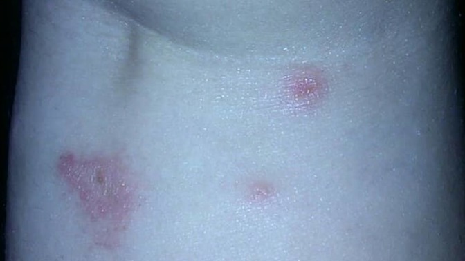 Is this ringworm?