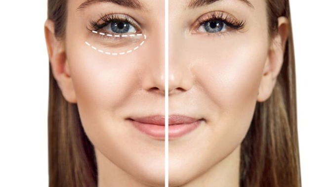 Do you find eyebags unattractive/attractive? At what age do people generally get it?