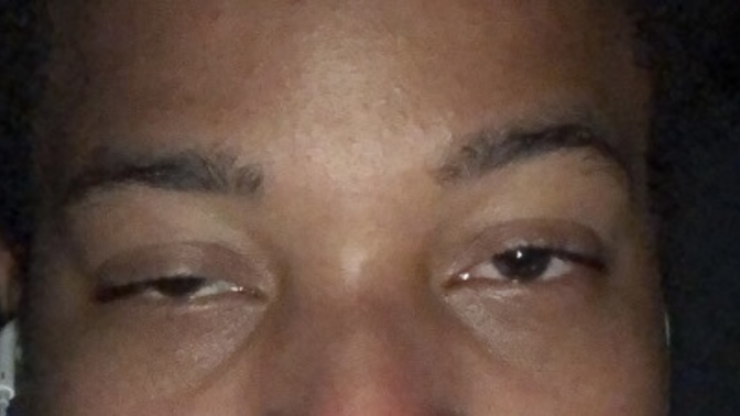 What is the probable cause of the left eye being significantly?