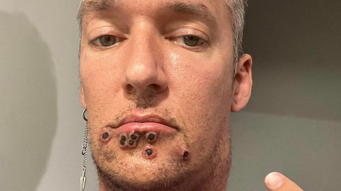 Would you go on a second date with someone if they had monkeypox?