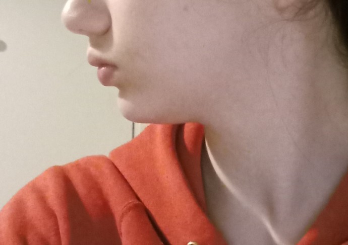 Would braces be able to fix my lower jaw?