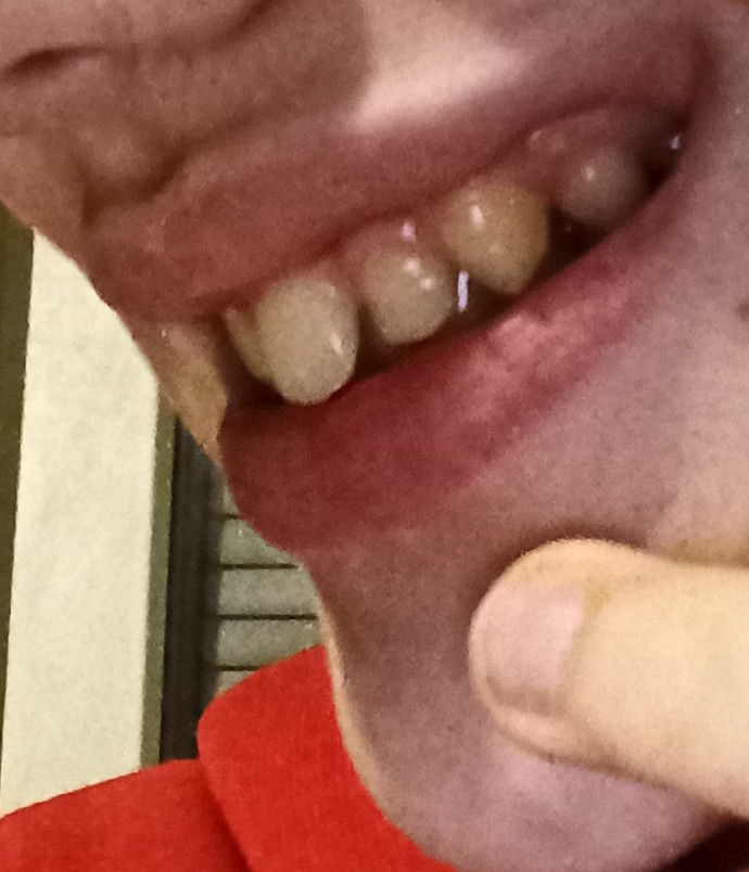 Would braces be able to fix my lower jaw?