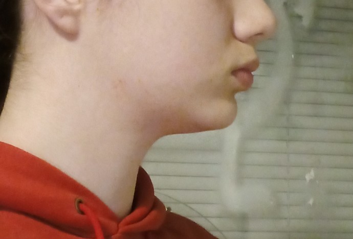 Would braces be able to fix my lower jaw?