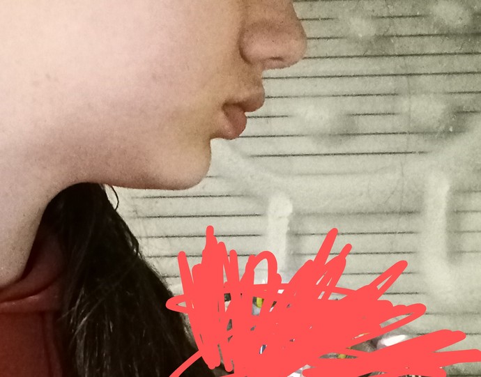 Would braces be able to fix my lower jaw?