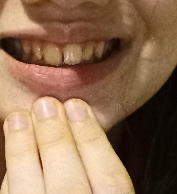 Would braces be able to fix my lower jaw?