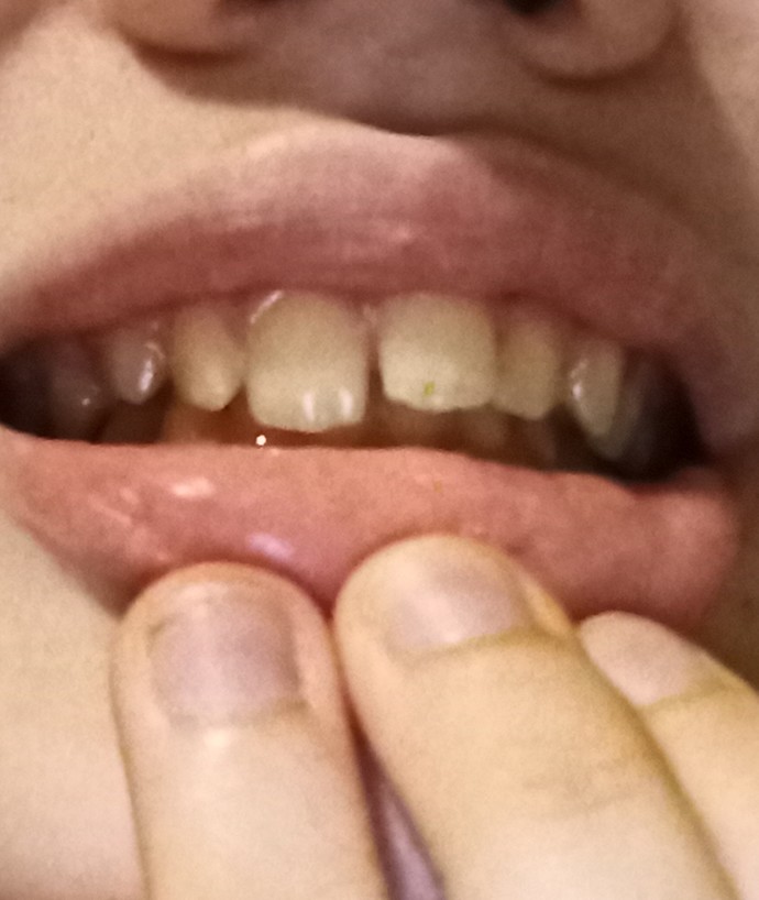 Would braces be able to fix my lower jaw?