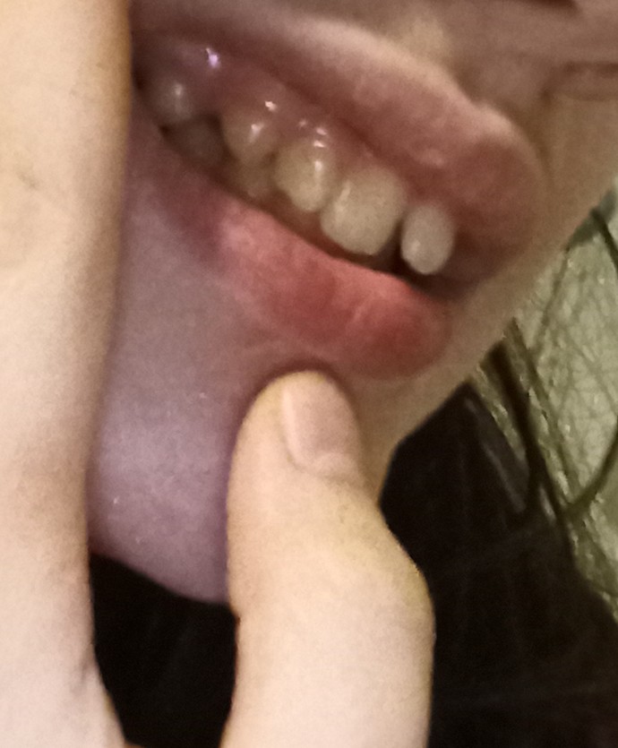 Would braces be able to fix my lower jaw?