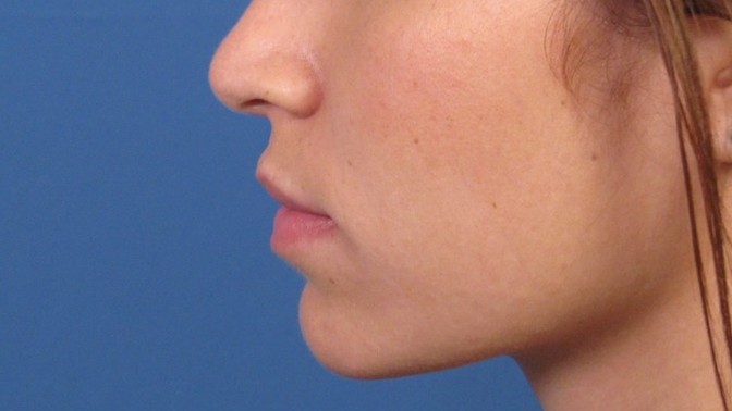 Would braces be able to fix my lower jaw?
