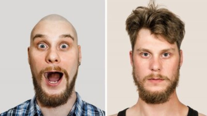 Is There Really A Cure For Hair Loss?