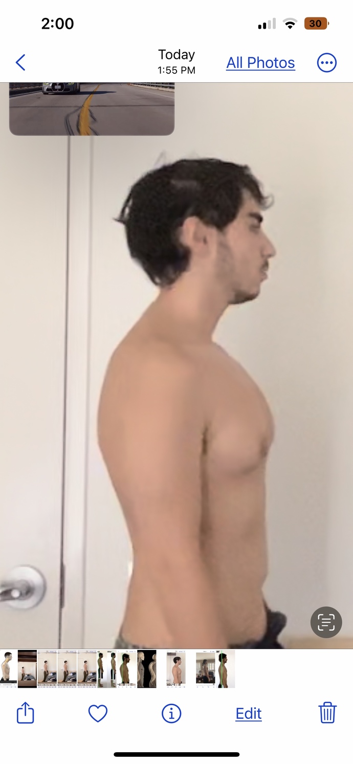 Would my hunchback be a dealbreaker for women?
