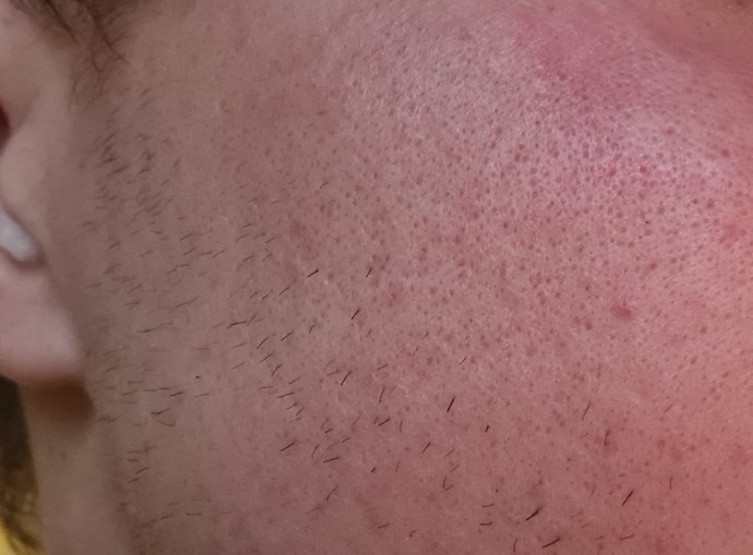 Skincare help, how to remove pores?